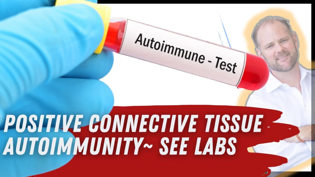 Positive connective tissue autoimmunity test Array 5 autoimmune panel blood work laboratory results.