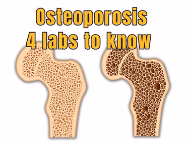 4 essential lab tests for osteoporosis detection: CRP homocysteine fasting insulin and ANA testing.
