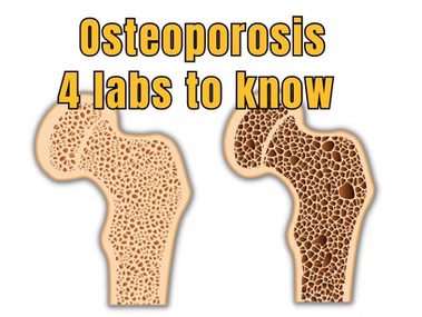4 essential lab tests for osteoporosis detection: CRP homocysteine fasting insulin and ANA testing.