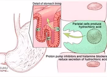 Diagram showing parietal cells producing hydrochloric acid in stomach lining and how PPIs inhibit acid secretion.