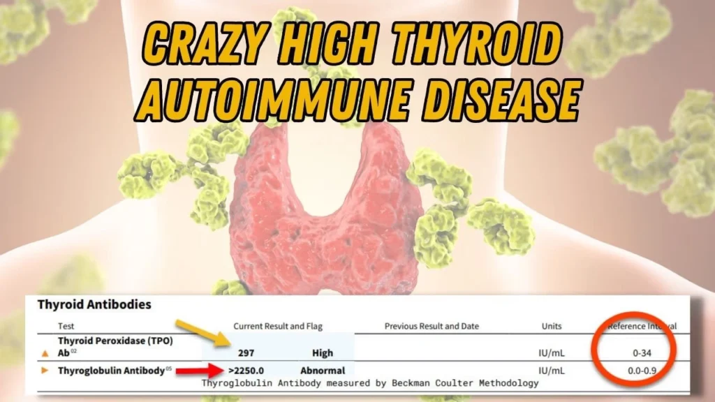 Lab test results showing high thyroglobulin antibodies (2250) and thyroid peroxidase antibodies (297), indicating Hashimoto’s thyroiditis.