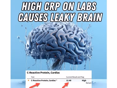 High CRP levels cause leaky brain barrier leading to brain fog and cognitive decline