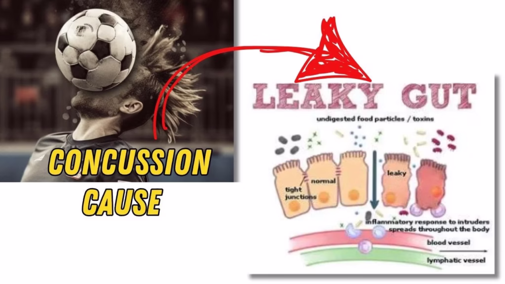 Diagram comparing healthy gut vs. leaky gut after concussion, showing intestinal barrier breakdown.