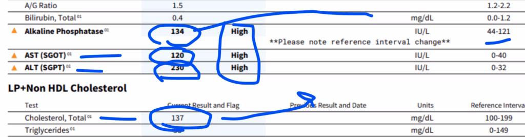 Lab test results showing elevated liver enzymes: ALT 207, AST 120, Alkaline Phosphatase 134, with normal bilirubin and cholesterol levels.