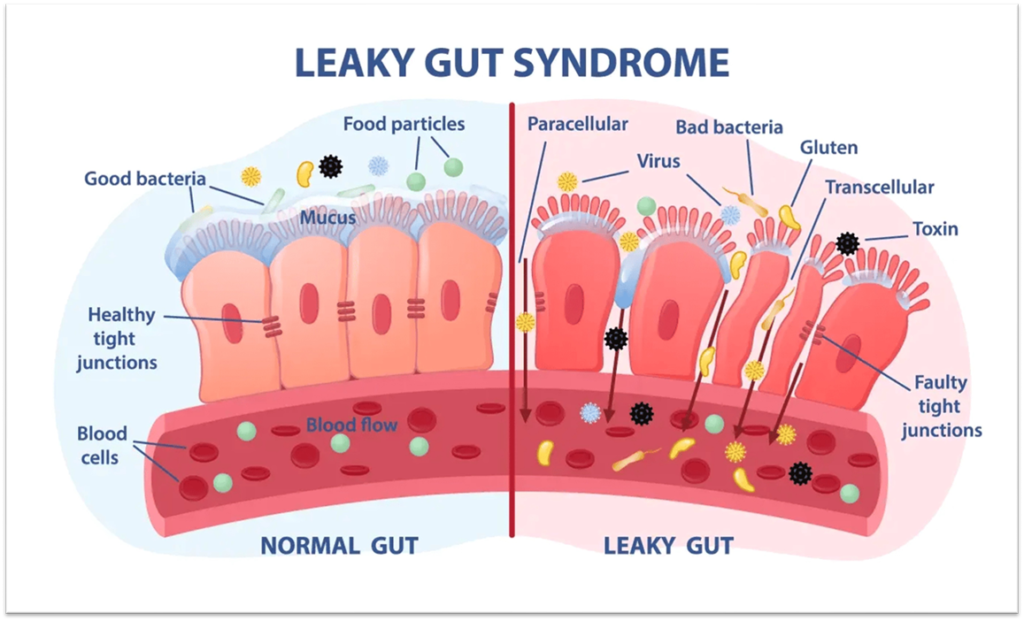 Side-by-side medical illustration comparing normal gut with healthy tight junctions to leaky gut with faulty junctions allowing toxins, bacteria, and food particles into bloodstream.